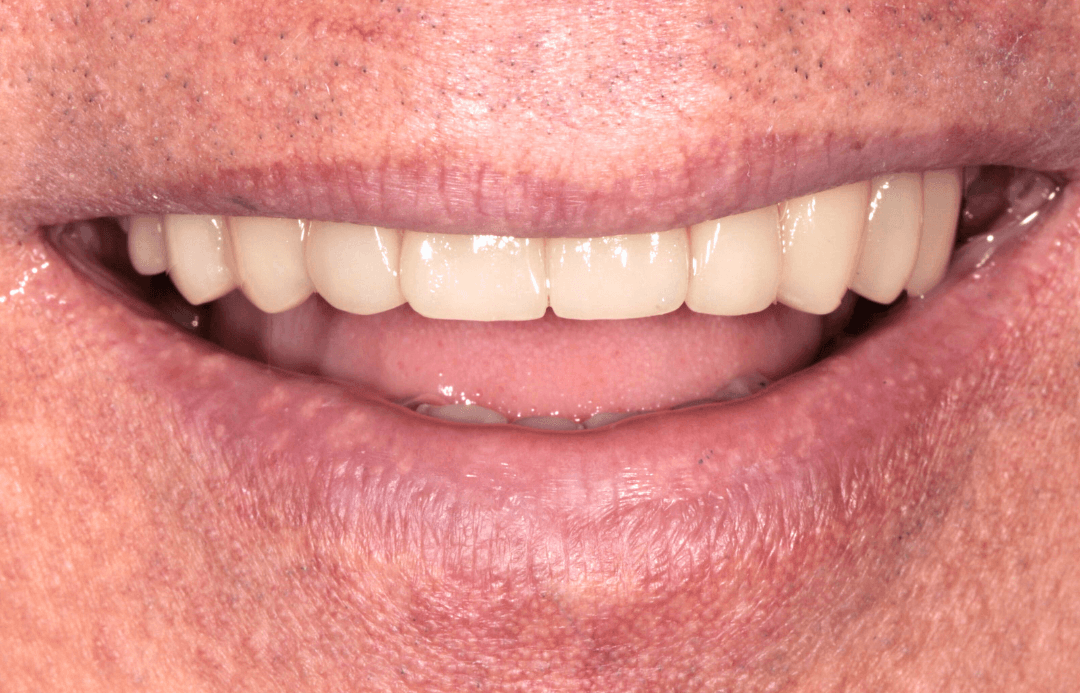 Sonrisa final - Resultado estático