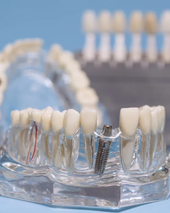 Modelo 3D de implantes dentales