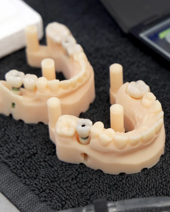 Modelos de implantes dentales y coronas