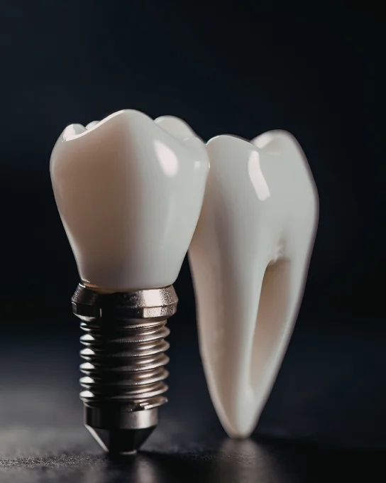 Implante dental con corona provisional