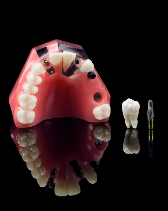 Implantes Dentales