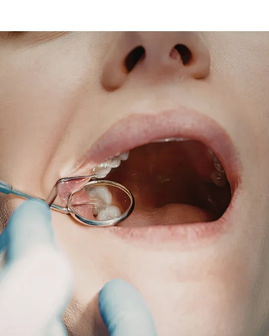 Tratamiento de Caries