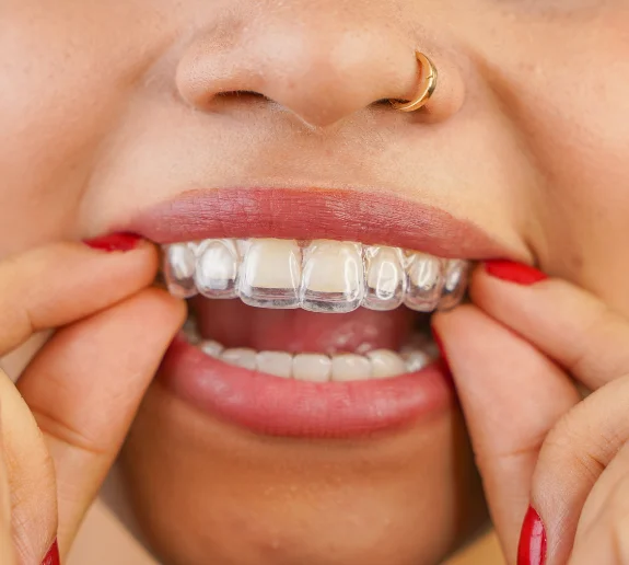 Invisalign