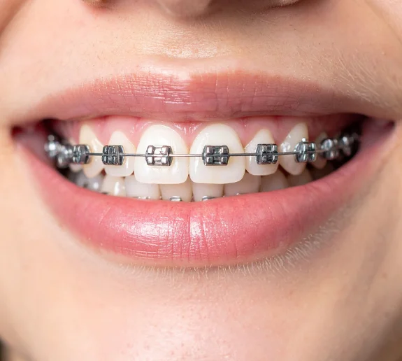 Brackets