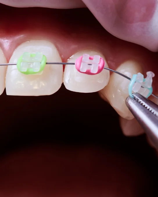 Brackets de Cerámica