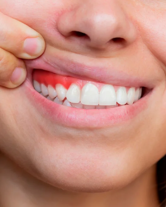 Periodontitis