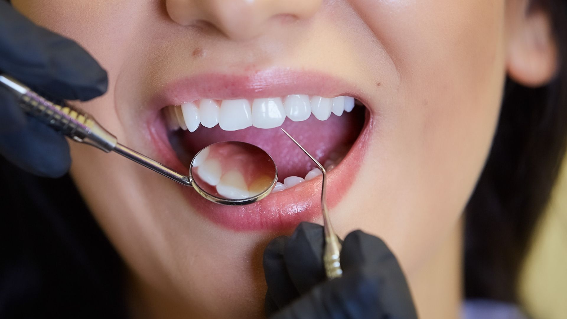 la piorrea dental